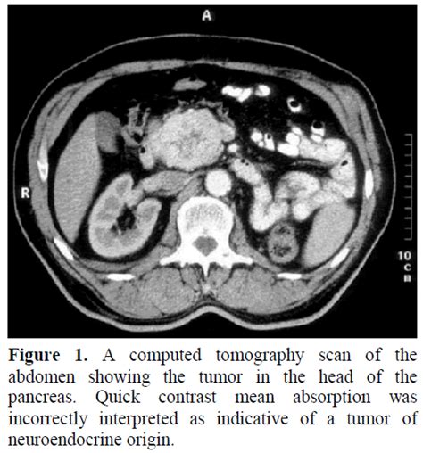 Surgical Treatment Of Pancreatic Metastases Of Renal Cell Carcinoma