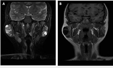 T2 Weighted A And T1 Weighted B Magnetic Resonance Imaging