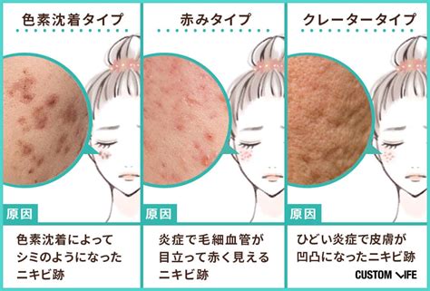 かご 無心 ミリメートル ニキビ 跡 ビタミン Hondojijp