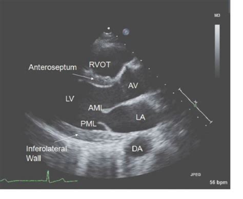 Echocardiography Flashcards Quizlet