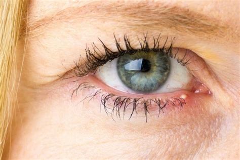 Juckende Augen Augenjucken Ursachen Behandlung Und Hausmittel