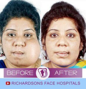 Everything You Must Know About Face Tumor Removal Surgery