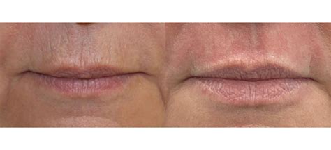 SMOKERS LINES: Best 2023 Treatment Brisbane - Cutis Dermatology