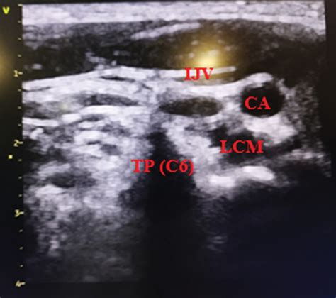 Full Article Effects Of Stellate Ganglion Block On The Perioperative