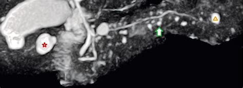 Zystische Tumore des Pankreas Diagnosezentrum Radiologie in Gießen