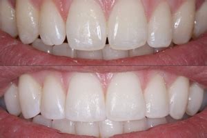 Dental Veneers vs. Cosmetic Bonding