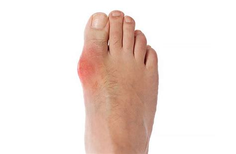 Cách Nhận Biết Dấu Hiệu Bệnh Gout ở Chân Và Cách điều Trị