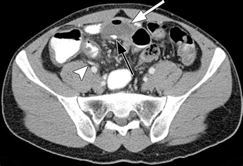 Meckel Diverticulum