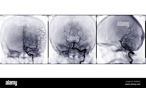 Collection Of Cerebral Angiography D Rendering Showing Cerebral Artery