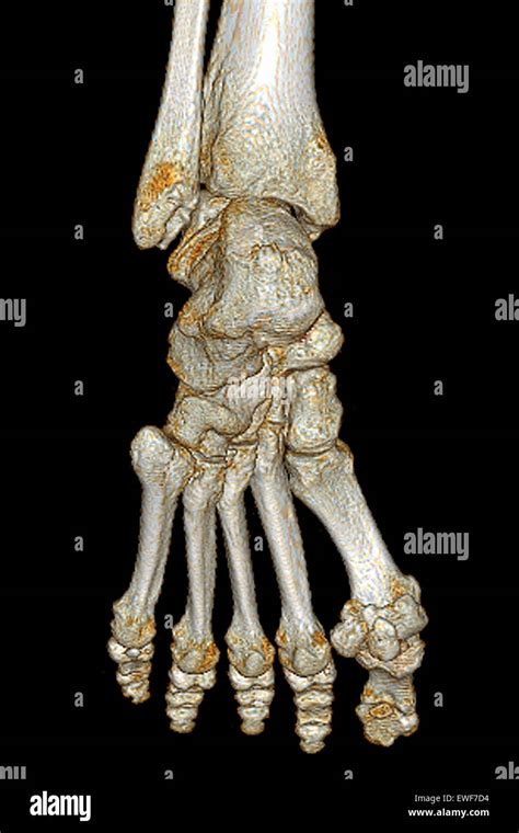 Hallux Valgus Ct Scan Stock Photo Alamy