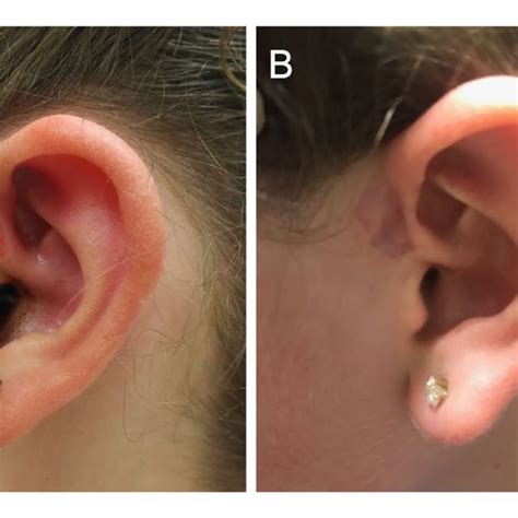 Post Operative Image Of Preauricular Sinus And Healing Of The Sinus