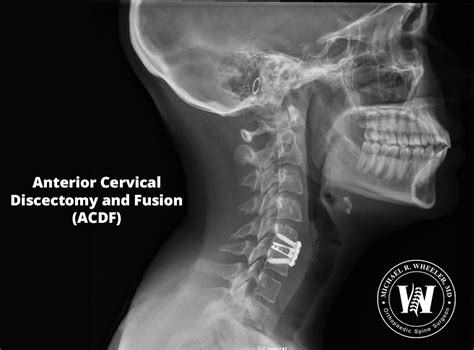 Dallas Anterior Cervical Discectomy And Fusion Acdf Michael R