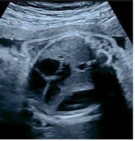 Congenital Diaphragmatic Hernia Ultrasound