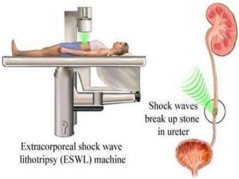 Laser Lithotripsypptx