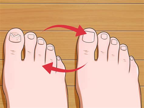 3 Ways to Prevent Nail Fungus - wikiHow