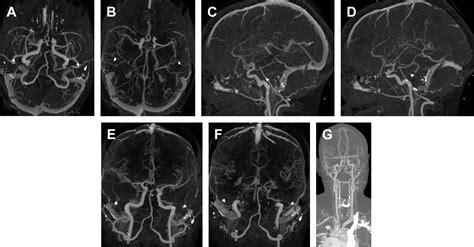 Dual Energy Computed Tomography Angiography Of The Head And Neck And