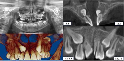 Three Dimensional Evaluation Of The Root Resorption Of Maxillary