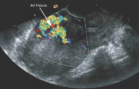 Arteriovenous Malformation Of The Uterus Associated With Secondary