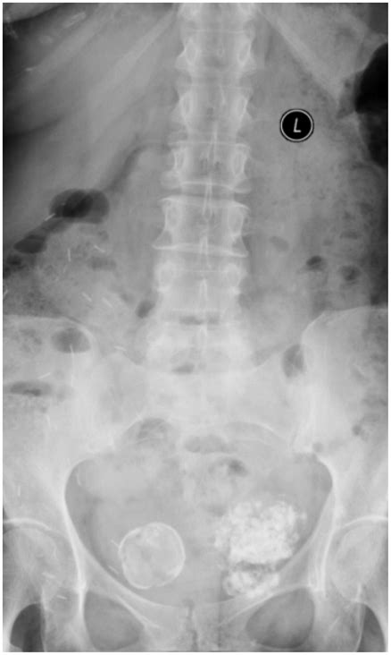 UTERINE FIBROIDS – A BIZARRE CALCIFIED MASS