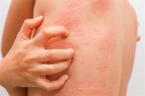 Hives Rash Skin Rash Itchy Skin Medlineplus Erofound