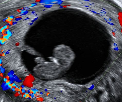 Diagnosis And Management Of First Trimester Miscarriage The Bmj