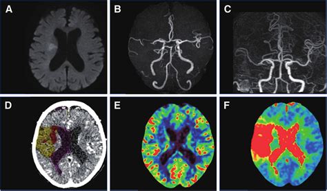 Analysis Of Head Mri Mra And Bayesian Ct Perfusion A Head Dwi Image