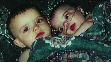 Identical Twin Born With Dwarfism Given 24 Hours To Live 2 Decades