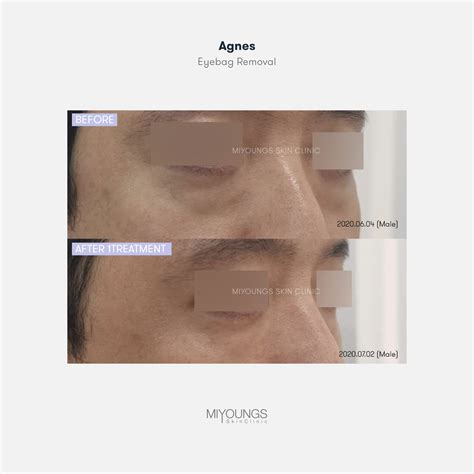 Agnes eyebags | MIYOUNGS