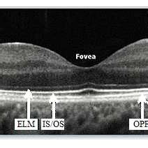 Optical Coherence Tomography Of Retina Showing Inner Limiting Membrane