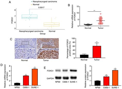 Foxg1 Expression Is Upregulated In Npc Tissues And Cells A Foxg1