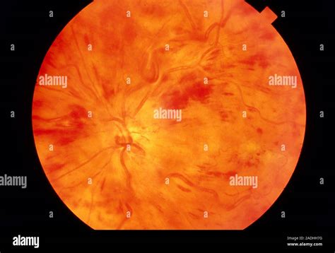 Crv Oclusi N Retiniana La Oftalmoscopia Vista De La Retina Del Ojo