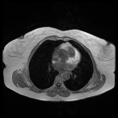 Bilateral Elastofibromas Dorsi Image Radiopaedia Org