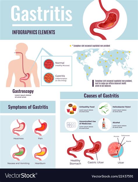 Gastritis Infographic Poster Royalty Free Vector Image 70632 Hot Sex Picture