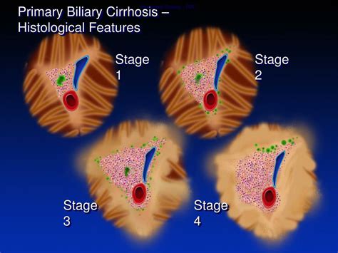 Ppt Cholestatic Liver Disease Pbc And Psc Powerpoint Presentation Free Download Id 5127077