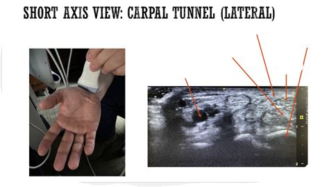 Lateral Carpal Tunnel Diagram Quizlet