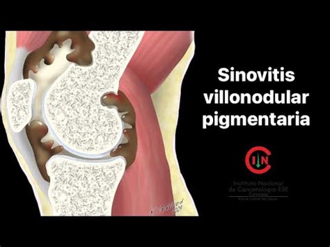 Sinovitis Villonodular Pigmentaria Youtube