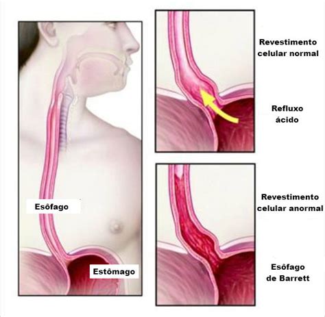 Esôfago o que é onde fica e função Toda Matéria