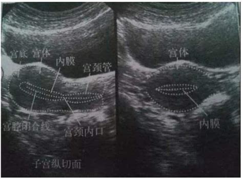 怎样看懂妇科b超检查报告 知乎