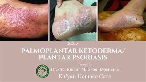 Case Of Palmoplantar Ketoderma Plantar Psoriasis Treatment Medicine In