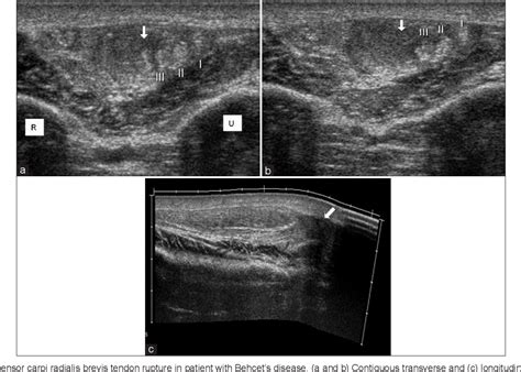 Figure From Ultrasound And Doppler Us In Evaluation Of Superficial