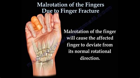 Metacarpal fracture - retiball