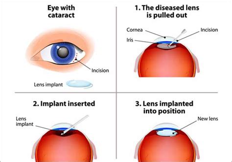 Best eye hospital in chennai for cataract surgery | Amrit