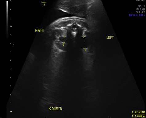 Prenatal Urinary Tract Dilatation Urologic Clinics