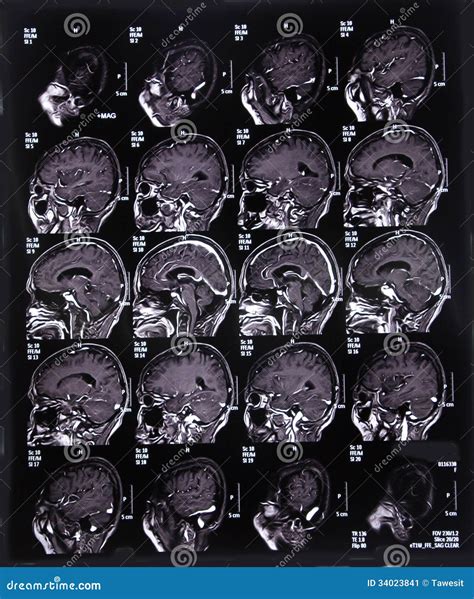 Mri脑子的扫描图象 库存图片 图片 包括有 头脑的 医学 爱好健美者 女主持人 题头 癌症 34023841