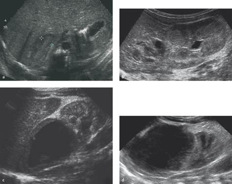 14 Adrenal Glands Radiology Key