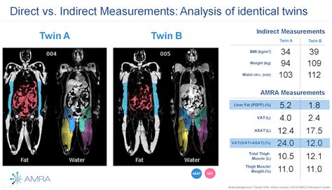 Beyond Bmi Amra Aims To Take Mri Fat Analysis Further