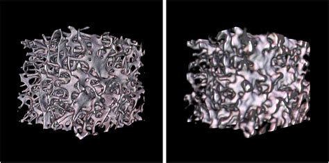 Trabecular Bone Microstructure Analysis On Data From A Novel Twin