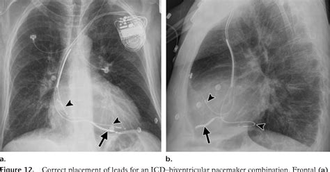 [pdf] Radiography Of Cardiac Conduction Devices A Comprehensive Review