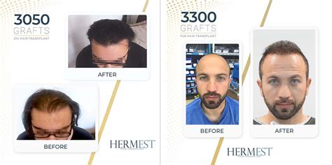 The Ultimate Guide To Hair Transplant Turkey Procedure Requirements