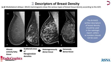 Ppt Bi Rads Terminology For Mammography Reports What Residents Need